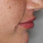 Lippenmodellierung Before & After Patient #1436