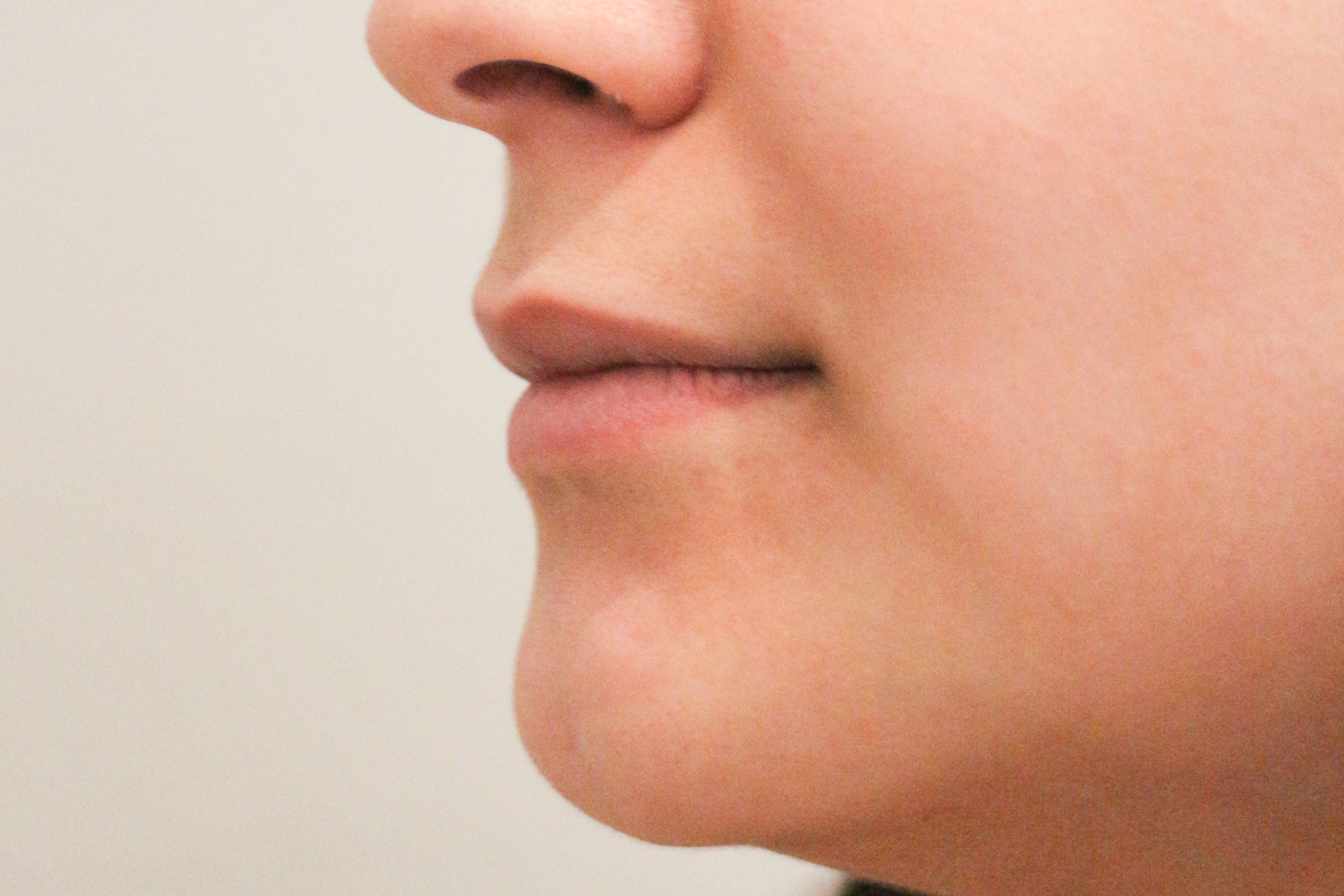 Lippenmodellierung Before & After Patient #1427