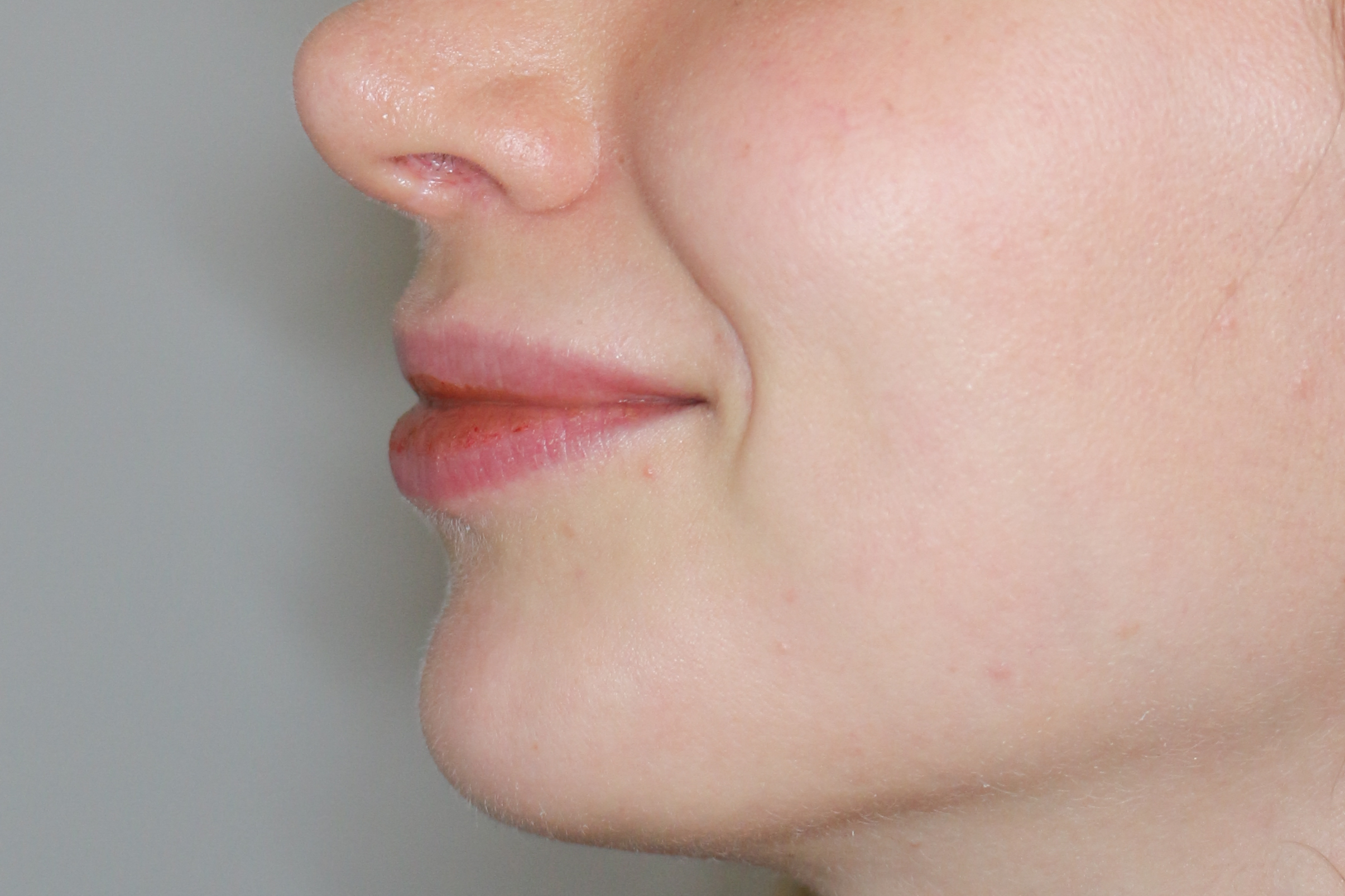 Lippenmodellierung Before & After Patient #1421