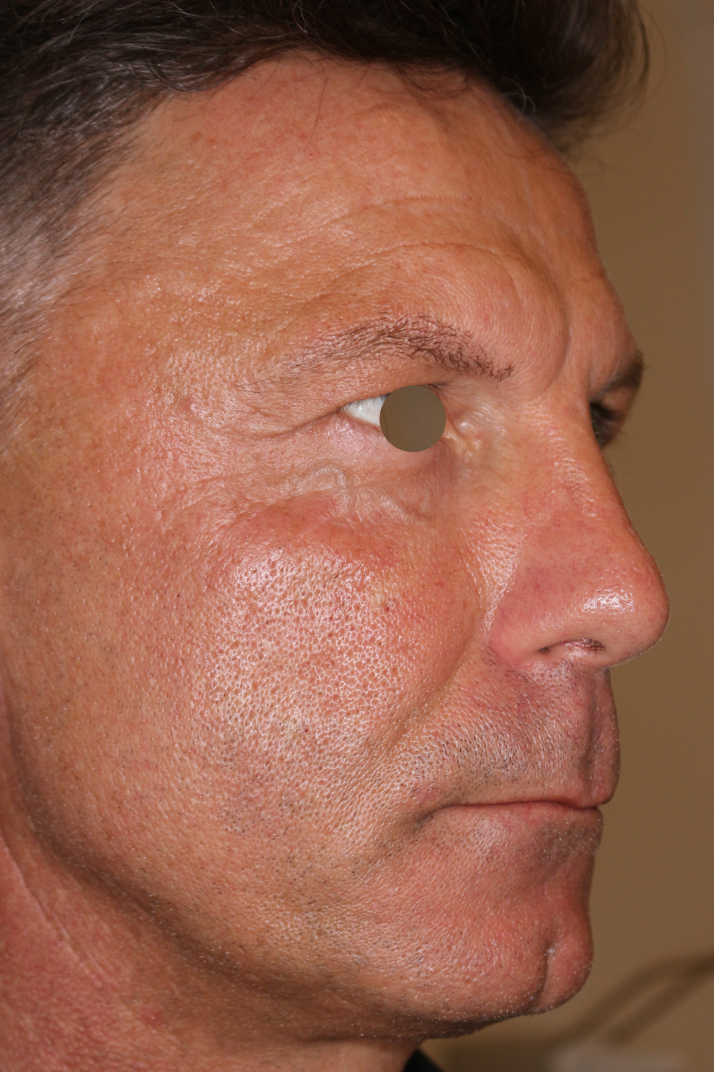 Hautunterspritzungen Before & After Patient #1409