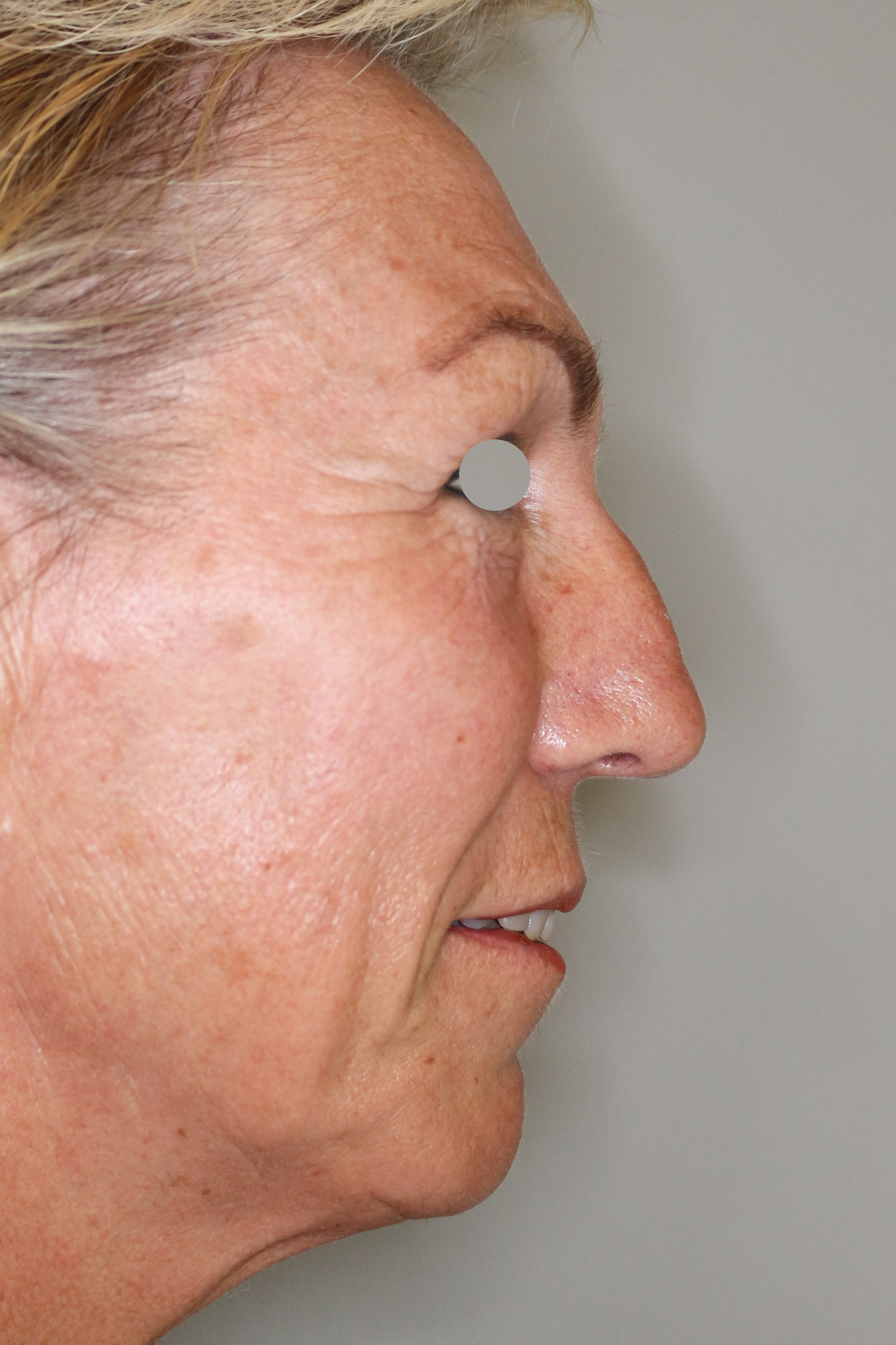 Hautunterspritzungen Before & After Patient #1397