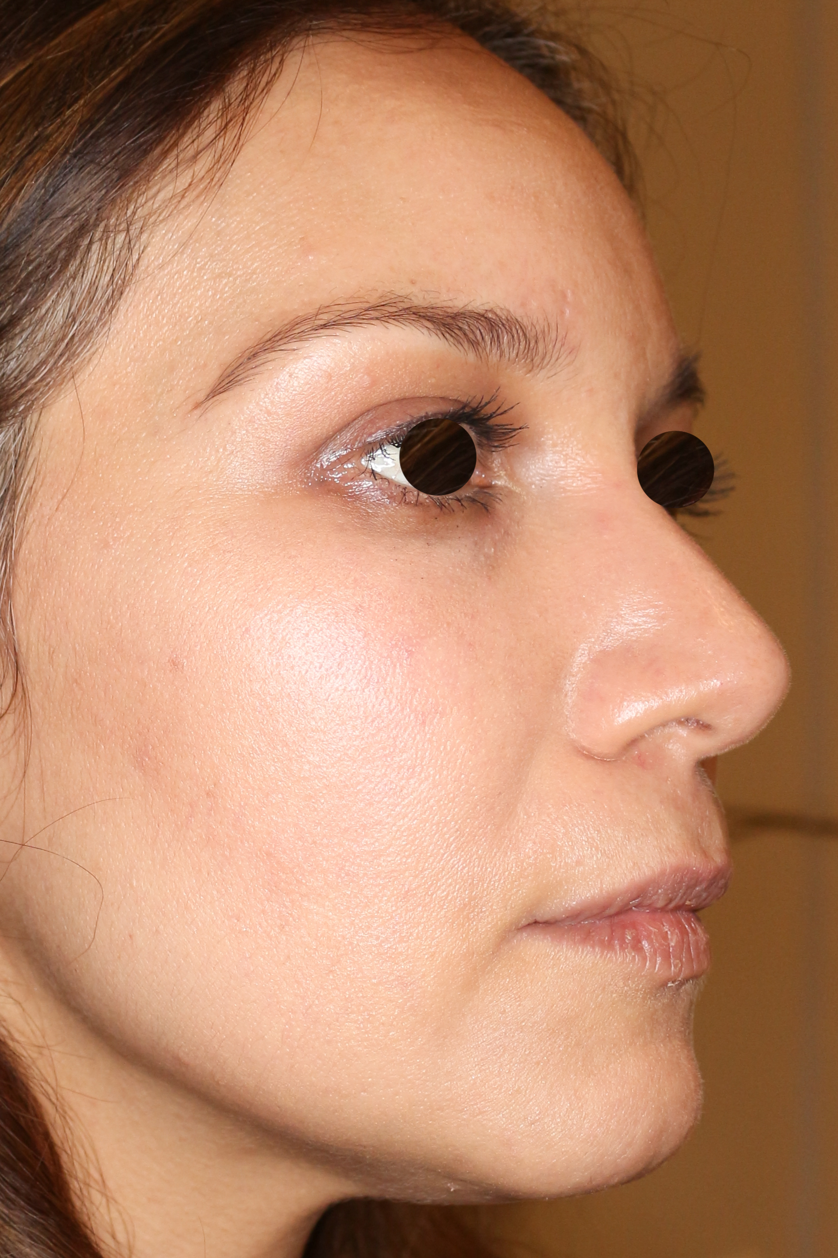 Hautunterspritzungen Before & After Patient #1391