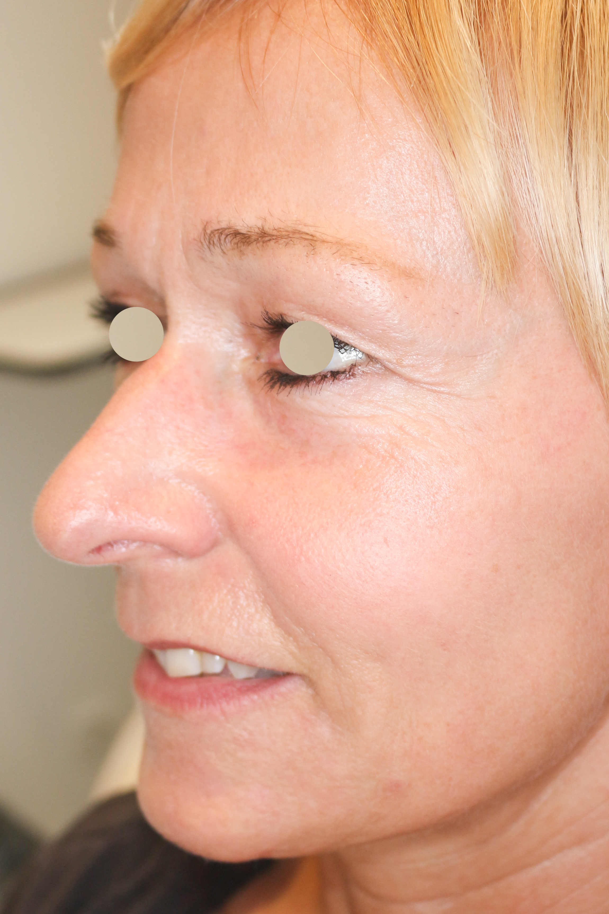 Hautunterspritzungen Before & After Patient #1388