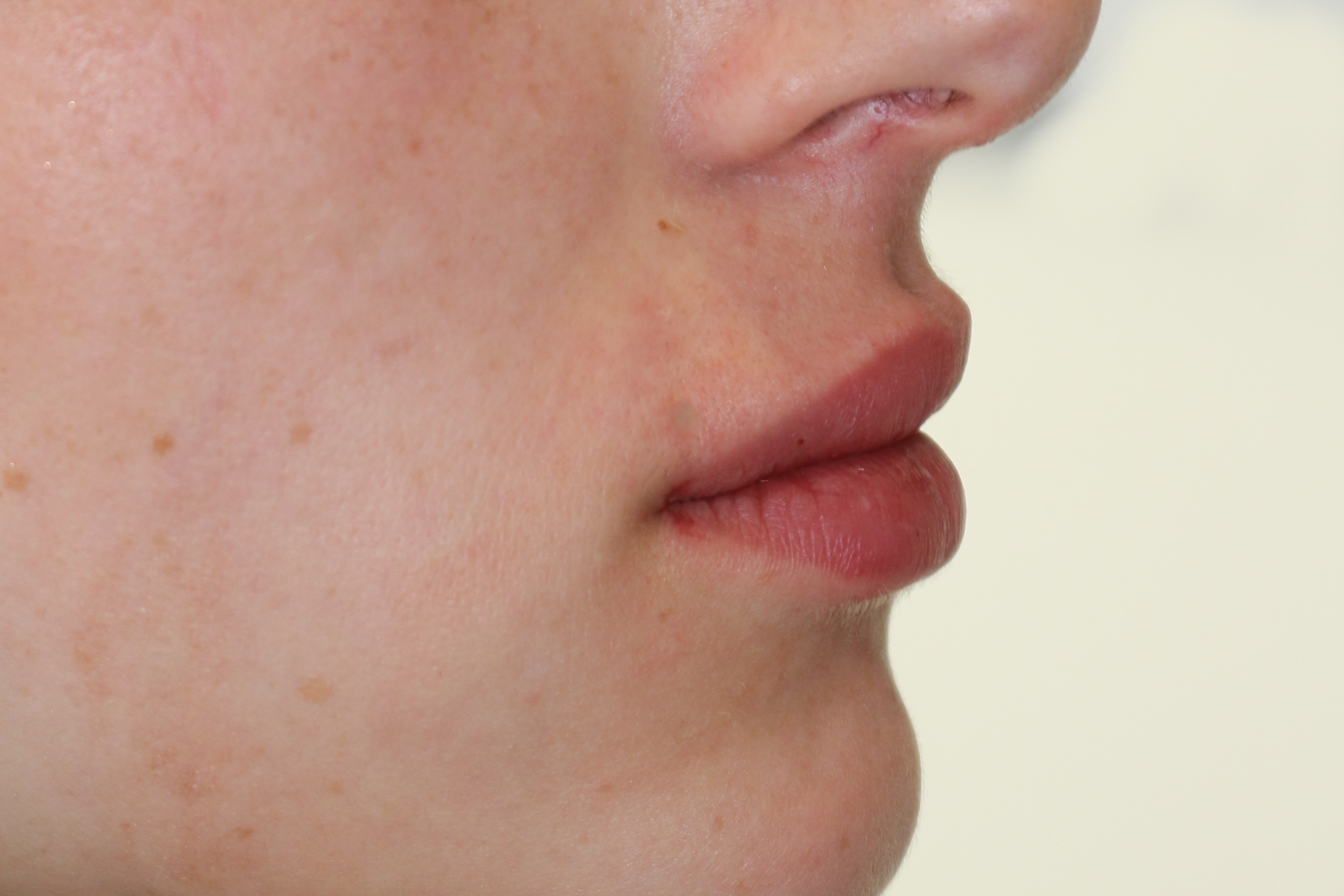 Lippenmodellierung Before & After Patient #1433