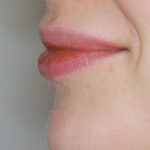 Lippenmodellierung Before & After Patient #1421