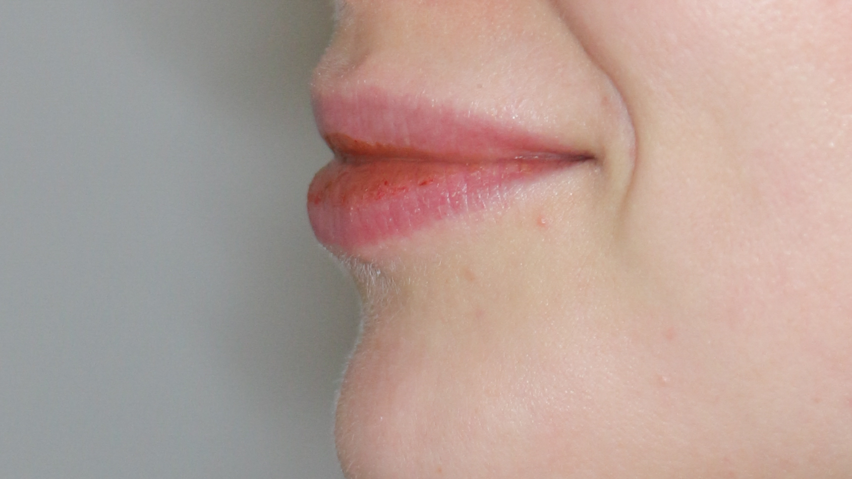 Lippenmodellierung Before & After Patient #1421