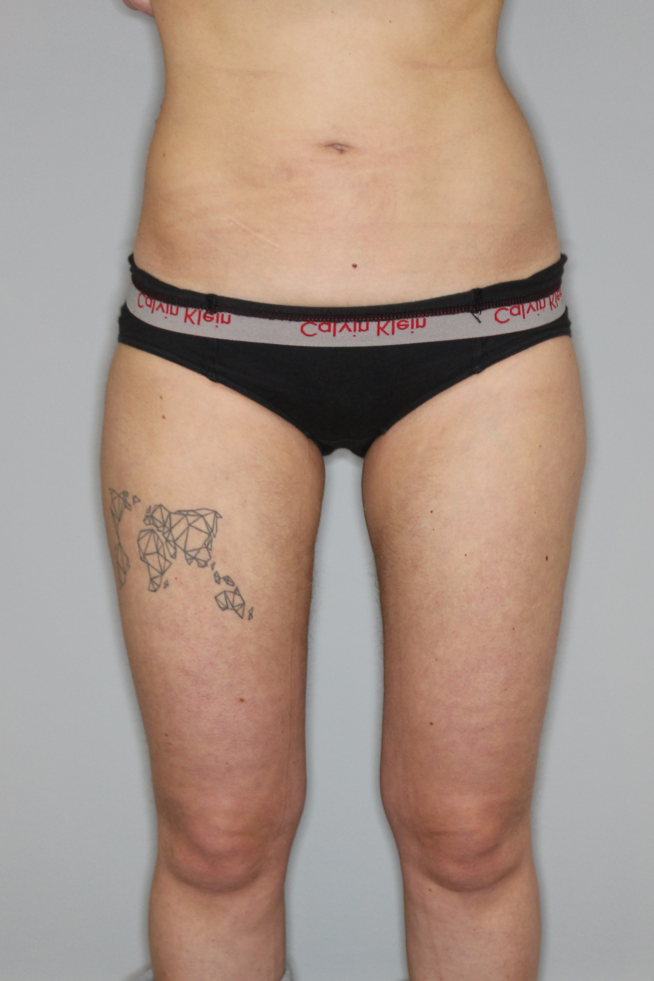 Fettabsaugung Before & After Patient #1509