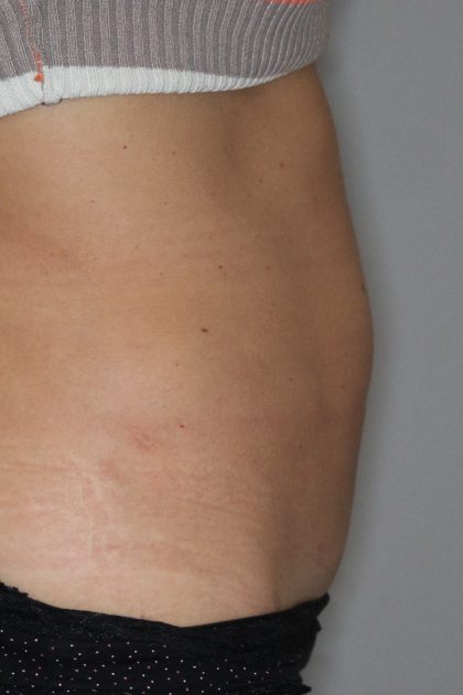 Bauchdeckenstraffung Before & After Patient #1479