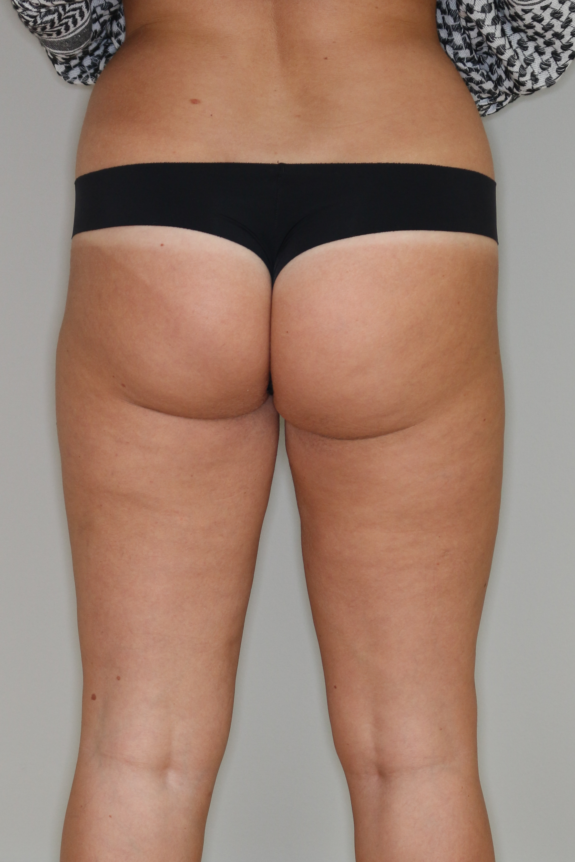 Fettabsaugung Before & After Patient #1503