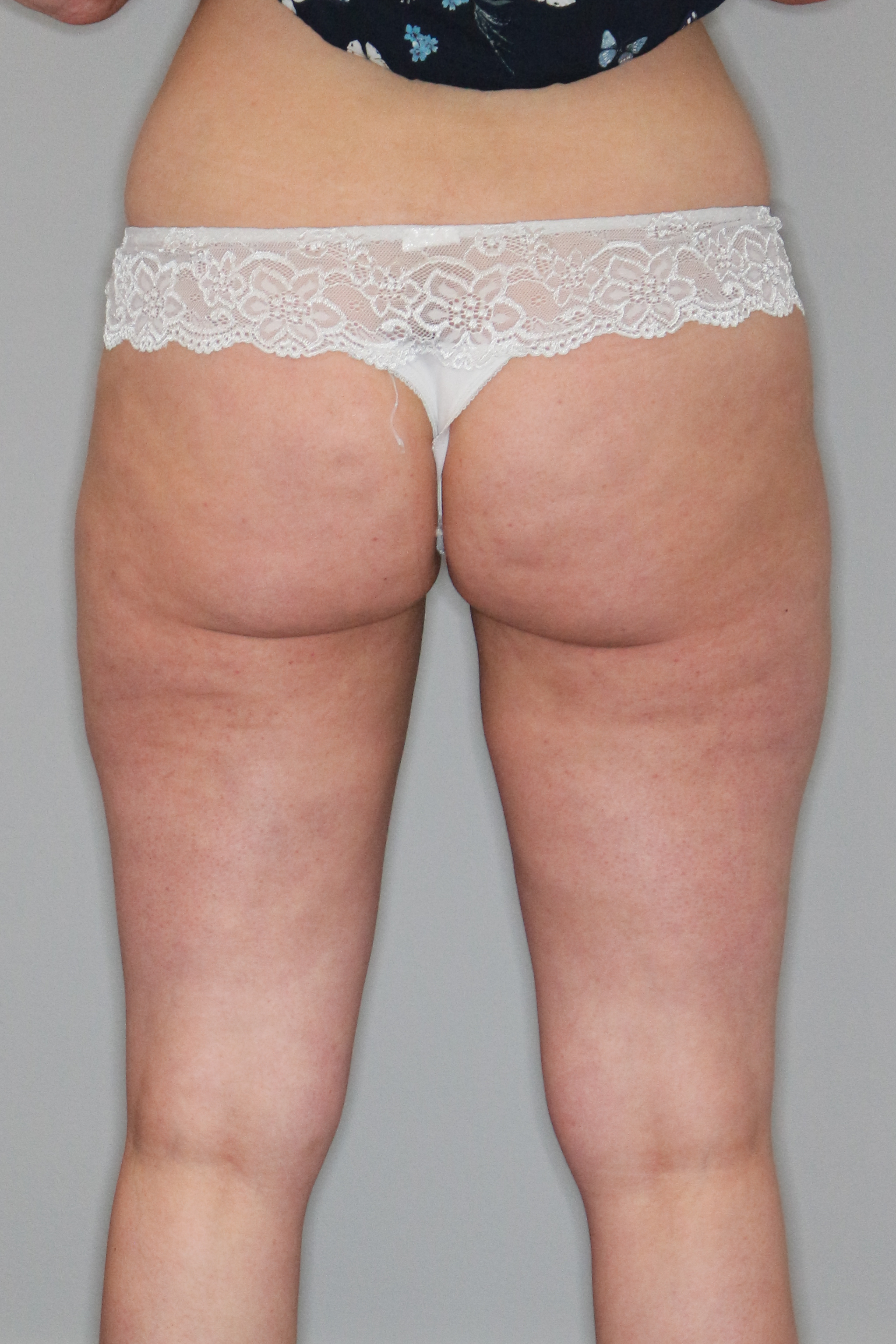 Fettabsaugung Before & After Patient #1485