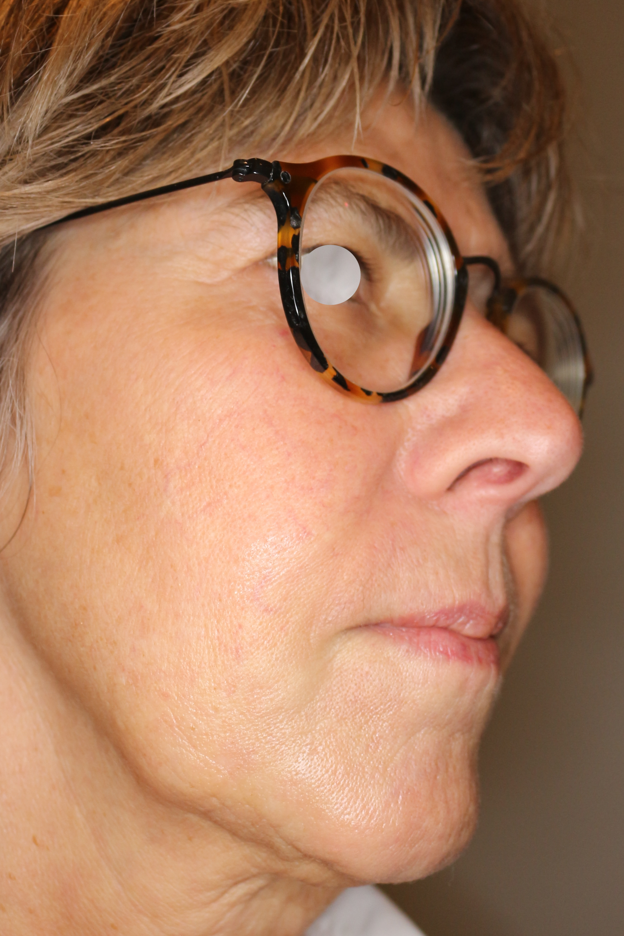 Faltenbehandlung Before & After Patient #1470