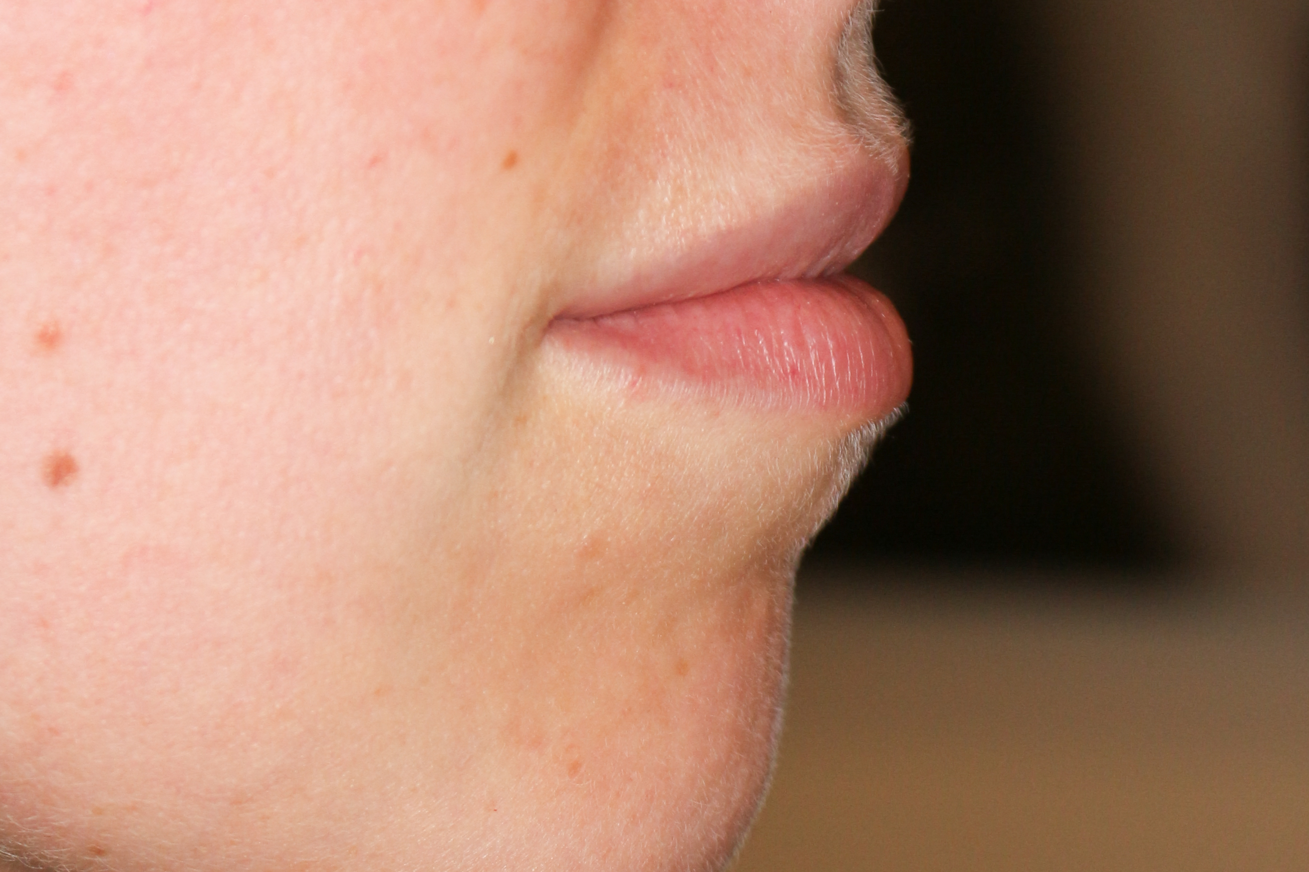 Lippenmodellierung Before & After Patient #1424