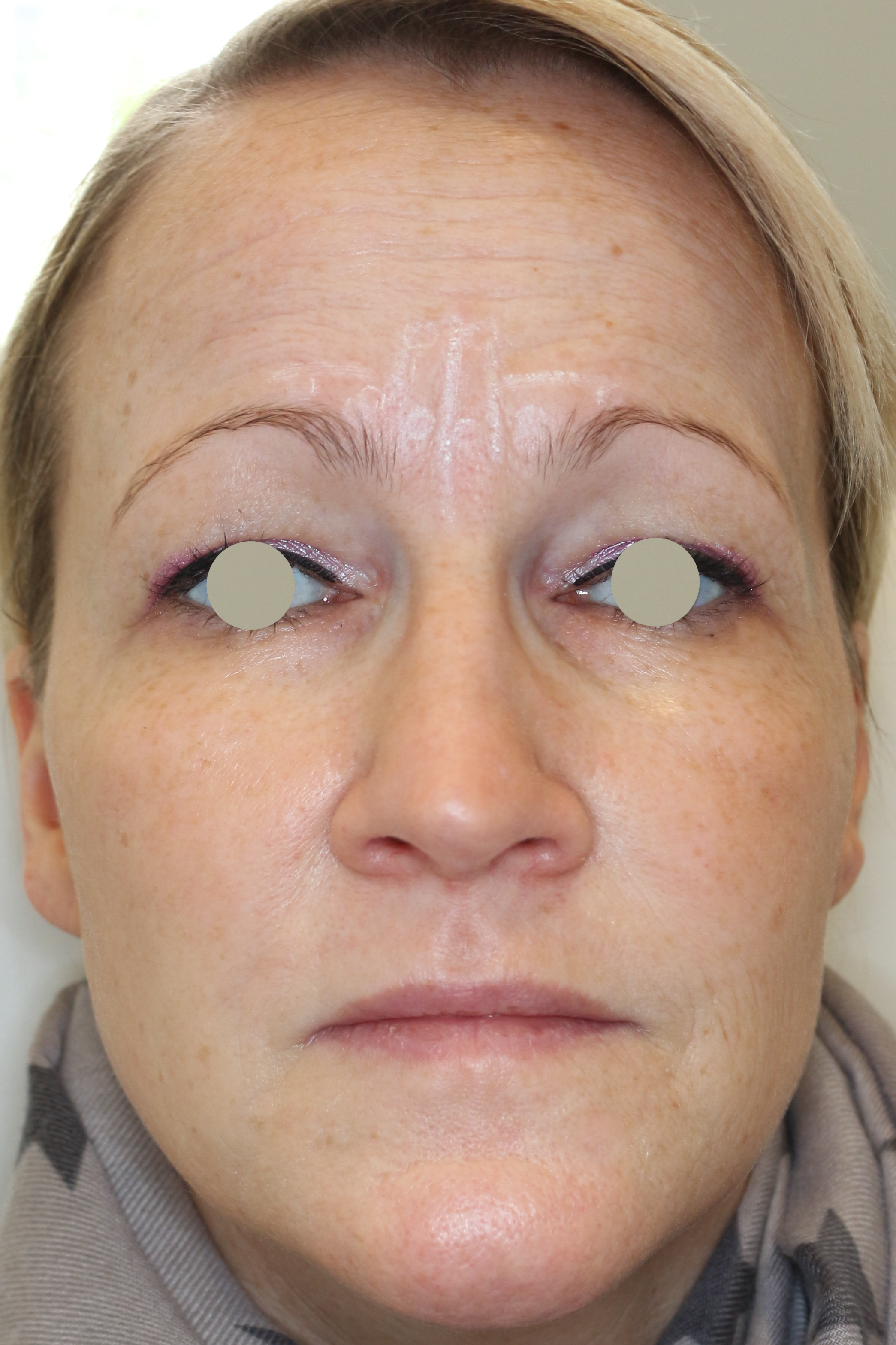 Hautunterspritzungen Before & After Patient #1412