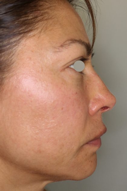 Hautunterspritzungen Before & After Patient #1406