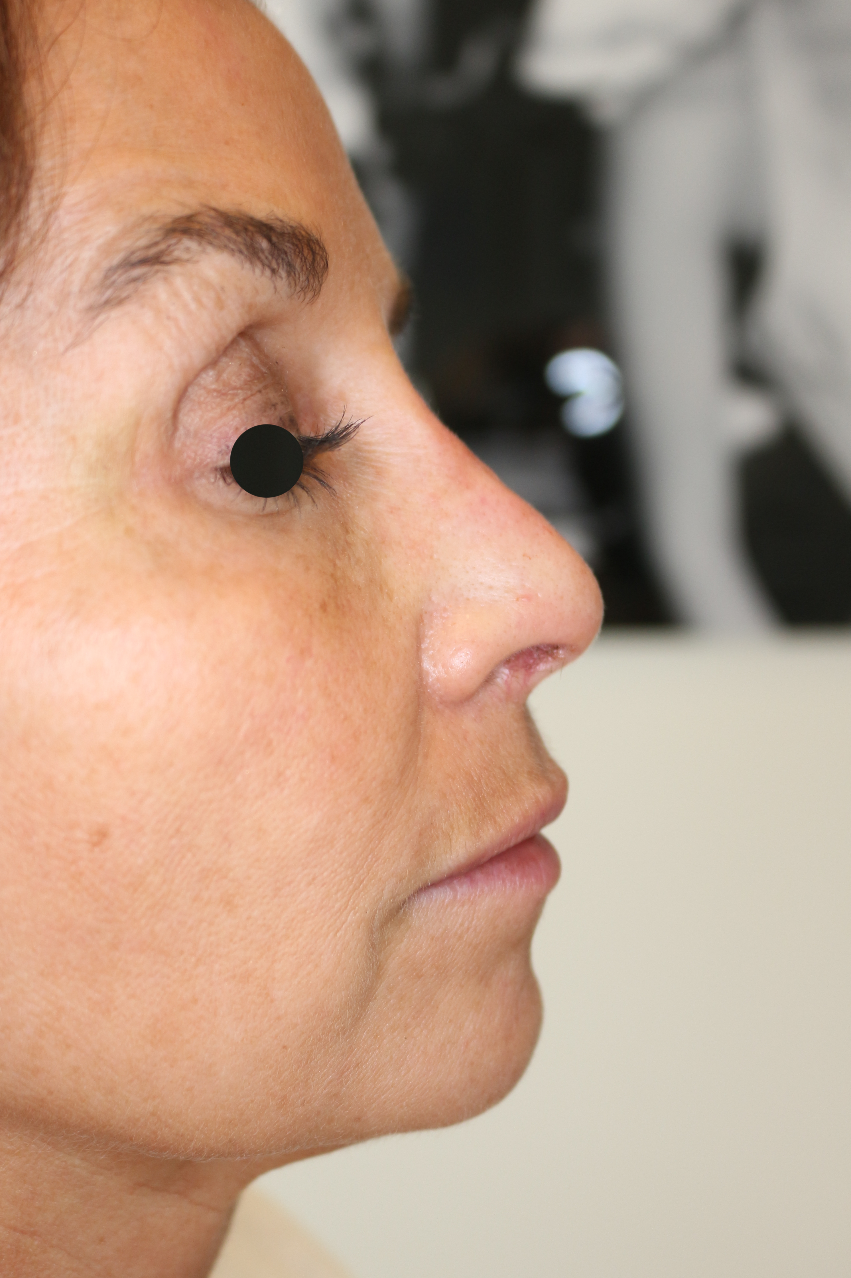 Hautunterspritzungen Before & After Patient #1385