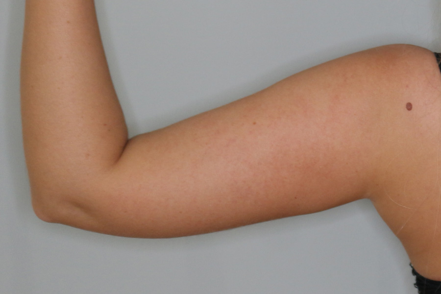 Fettabsaugung Before & After Patient #1506