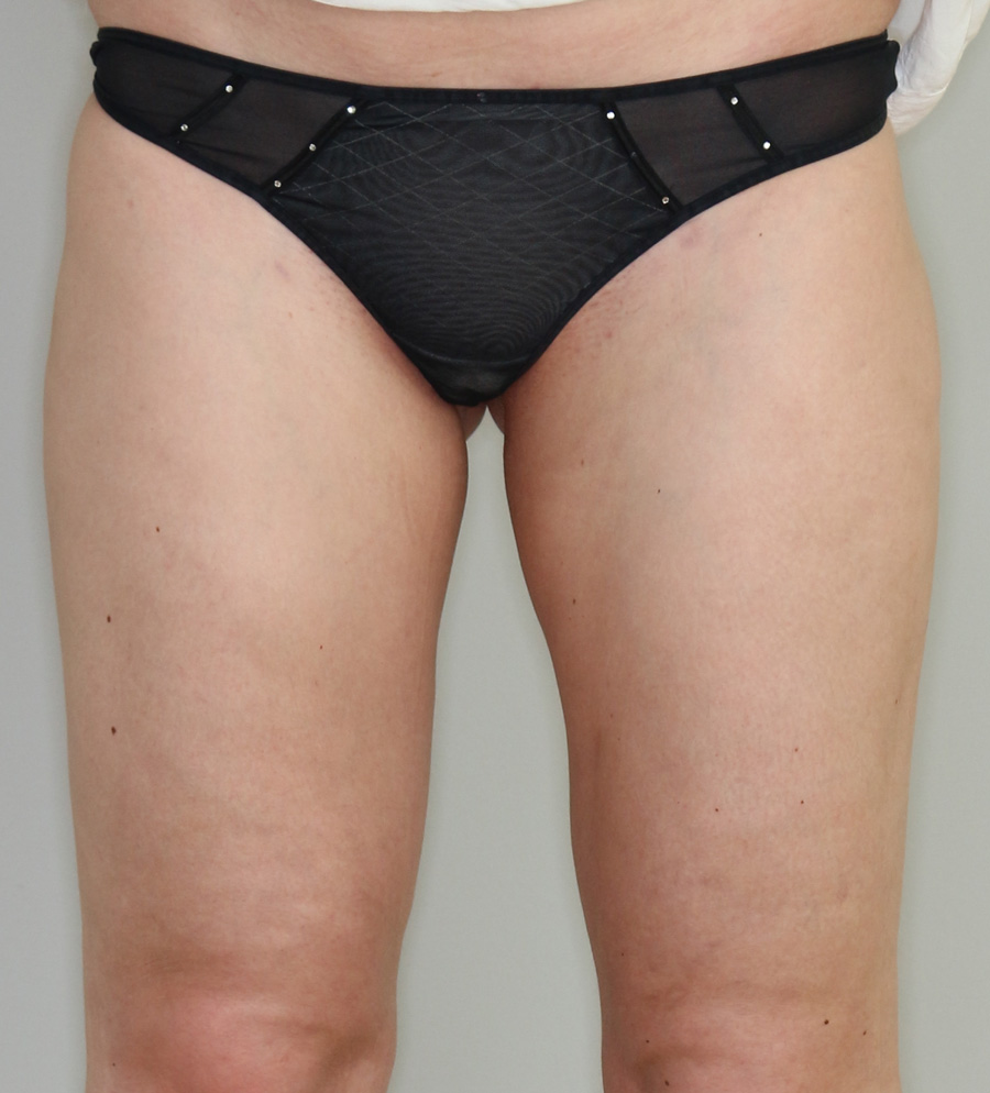 Fettabsaugung Before & After Patient #1491