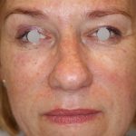 Augenlid- und Wangenmodellierung Before & After Patient #1449