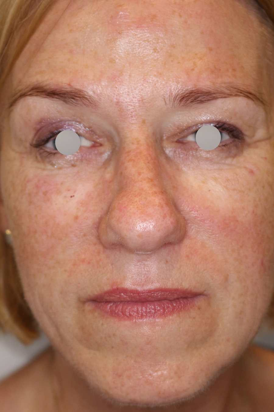 Augenlid- und Wangenmodellierung Before & After Patient #1449