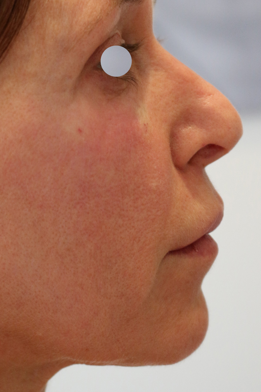 Augenlid- und Wangenmodellierung Before & After Patient #1464