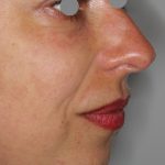Augenlid- und Wangenmodellierung Before & After Patient #1442