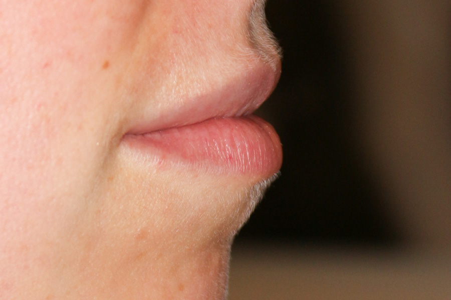 Lippenmodellierung Before & After Patient #1424
