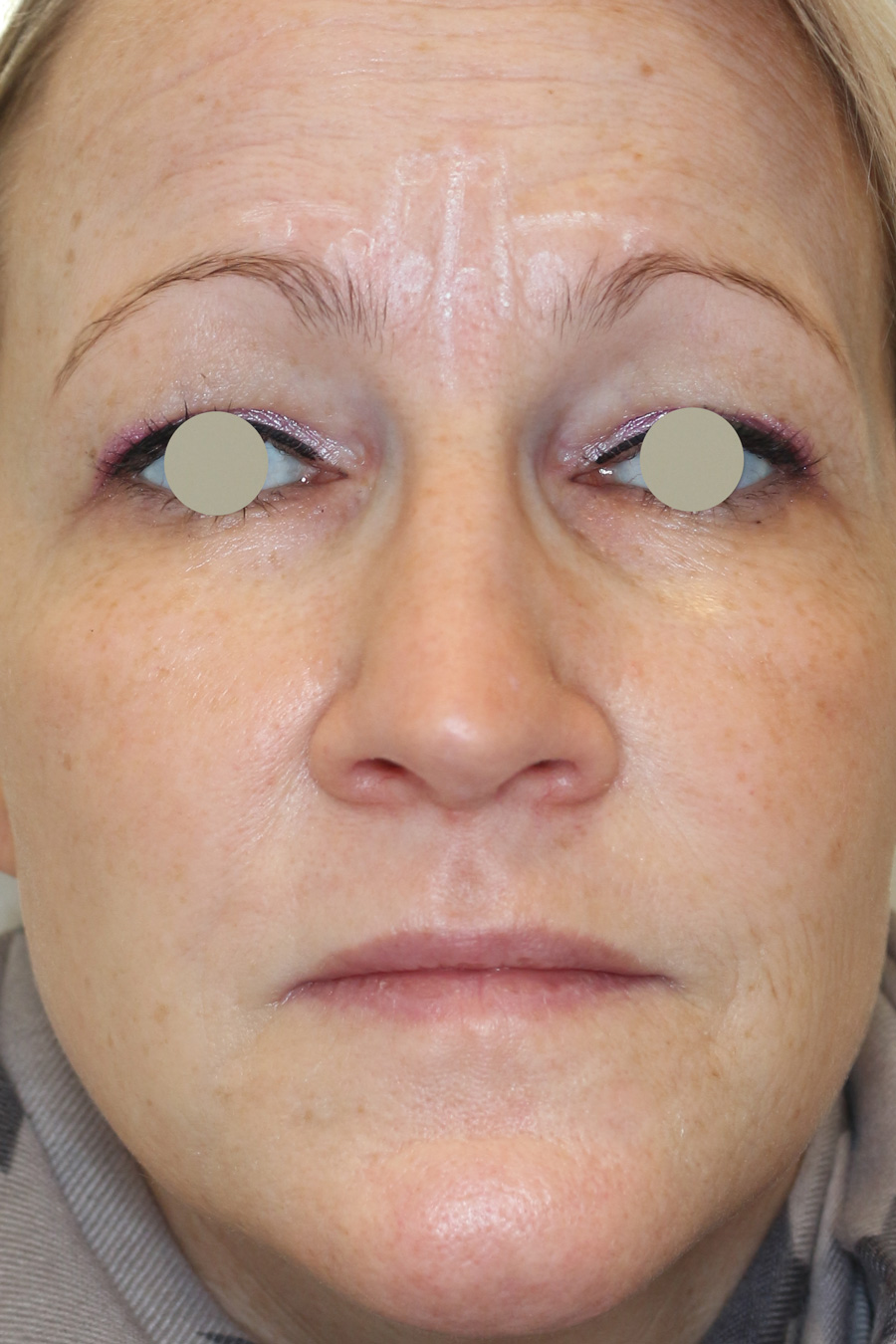 Hautunterspritzungen Before & After Patient #1412