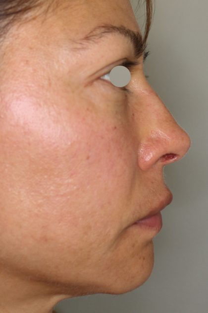 Hautunterspritzungen Before & After Patient #1406