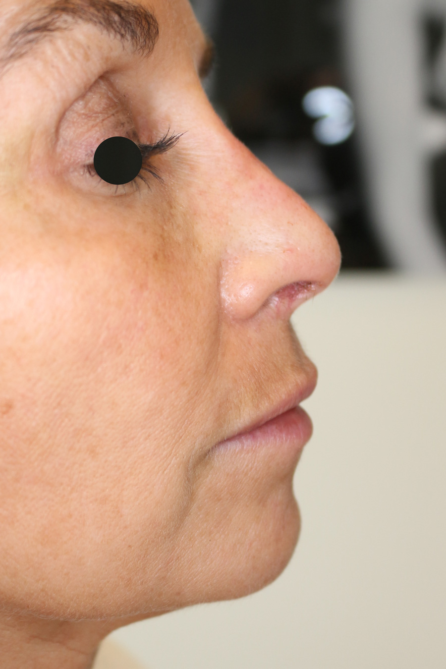 Hautunterspritzungen Before & After Patient #1385