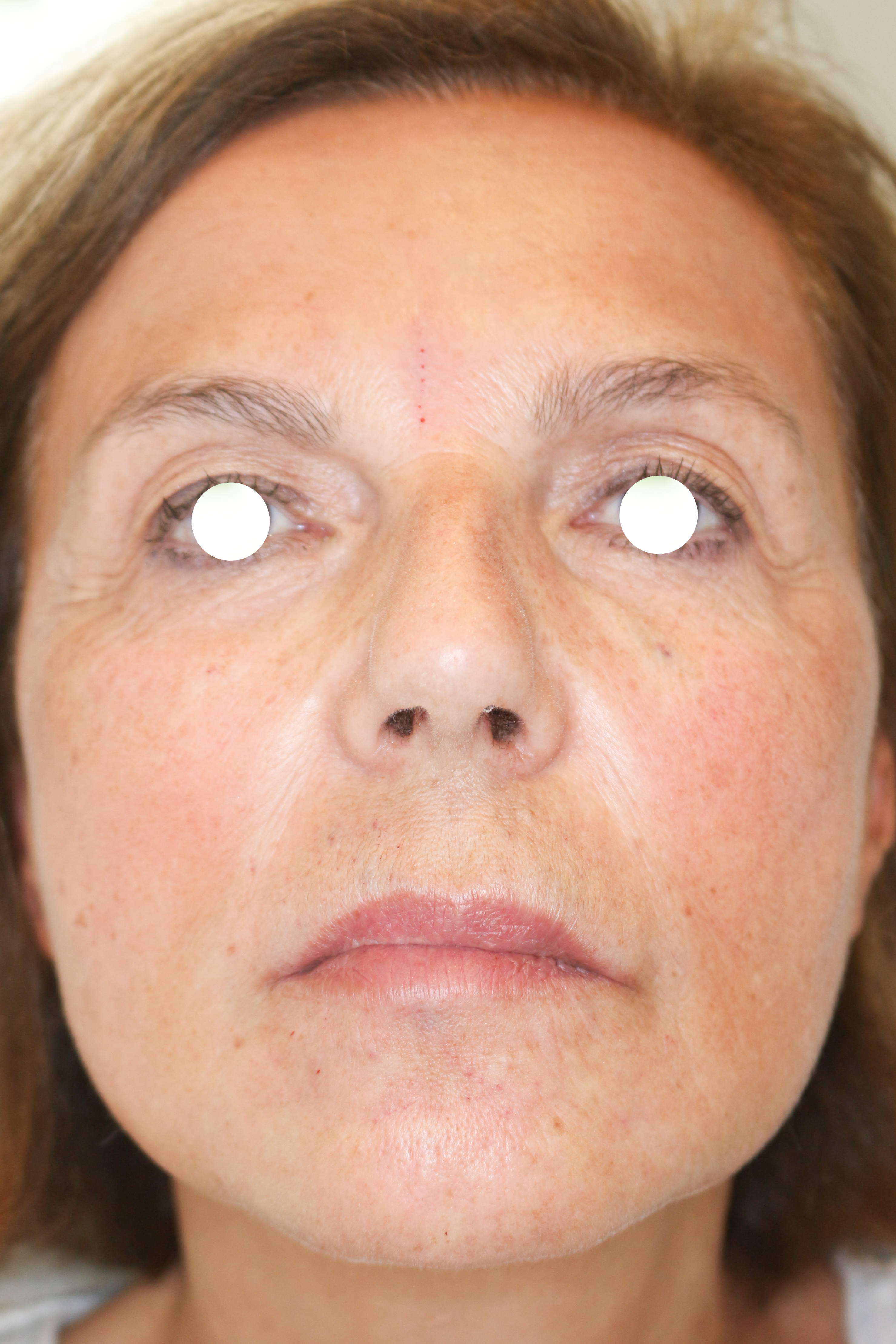 Hautunterspritzungen Before & After Patient #1400