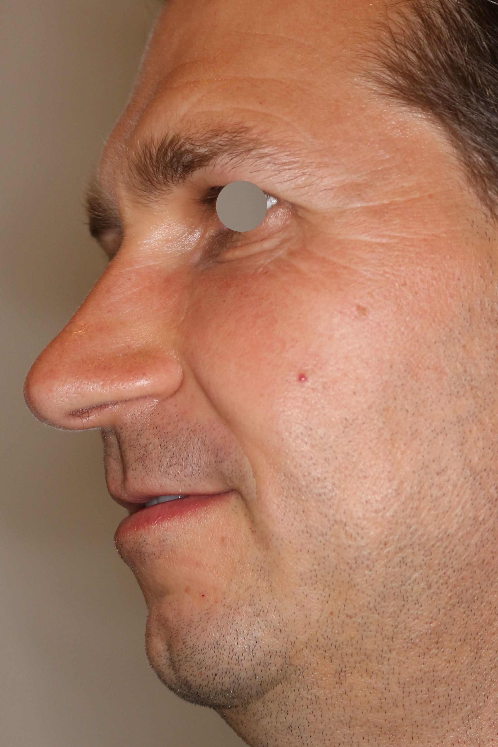 Augenlid- und Wangenmodellierung Before & After Patient #1461