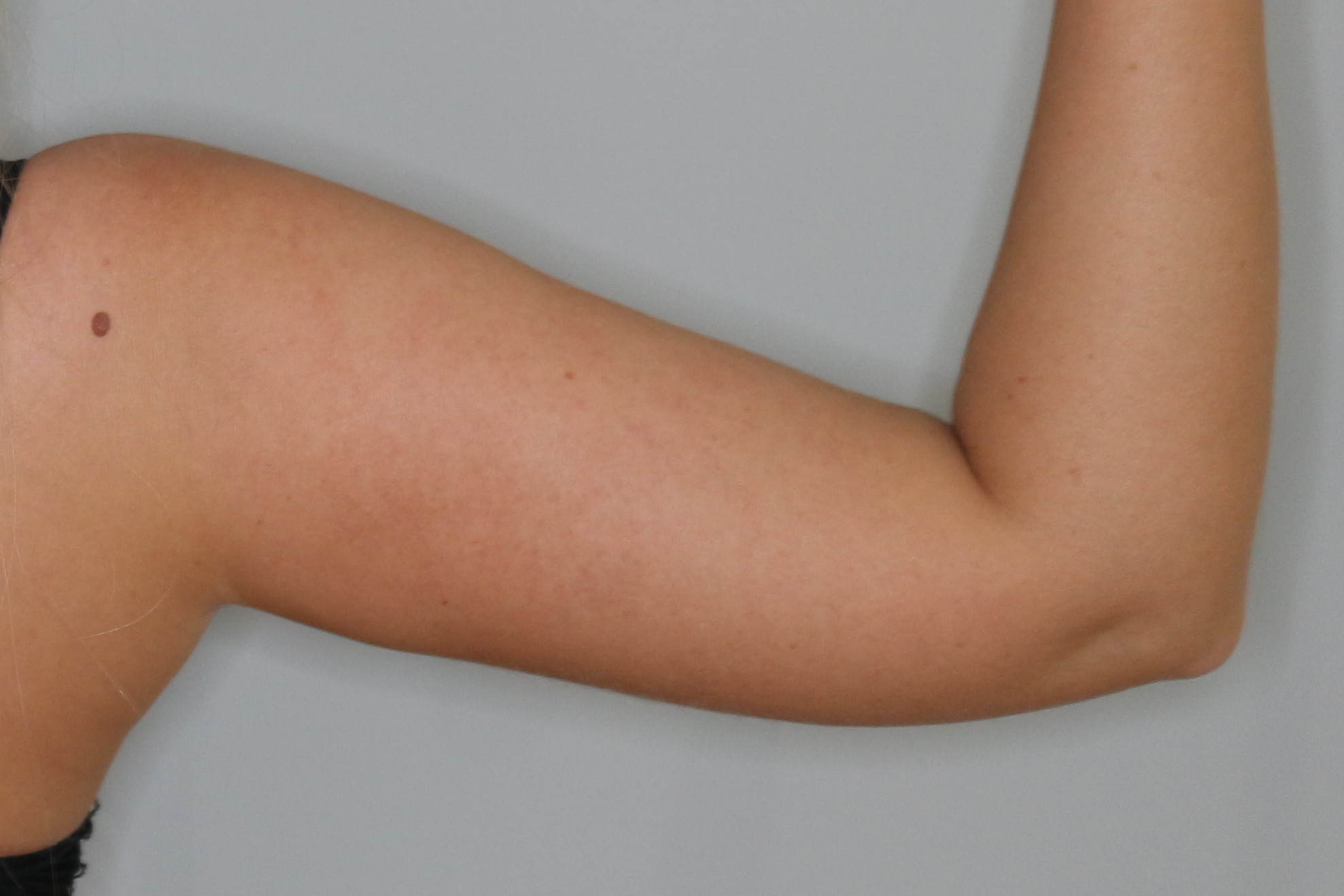 Fettabsaugung Before & After Patient #1506