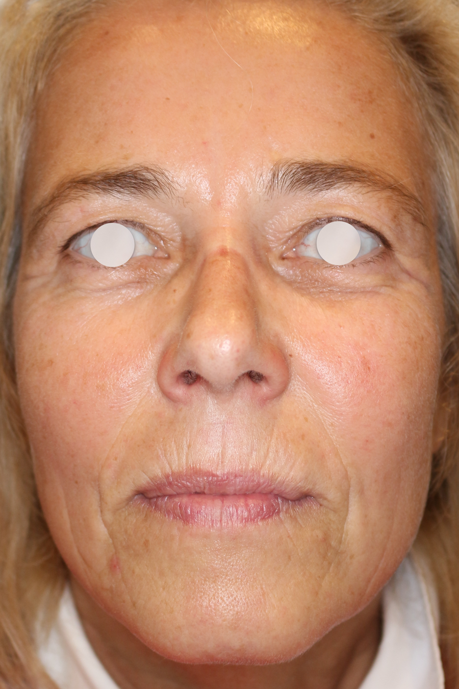 Faltenbehandlung Before & After Patient #1476