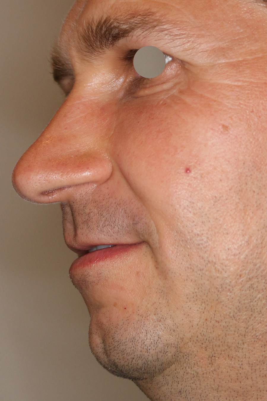 Augenlid- und Wangenmodellierung Before & After Patient #1461