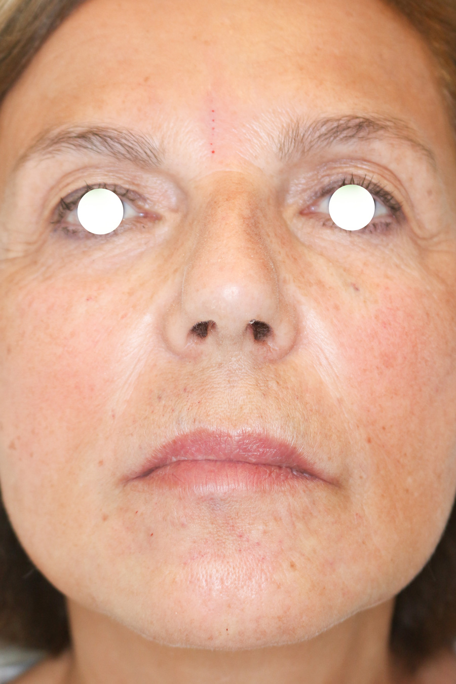 Hautunterspritzungen Before & After Patient #1400