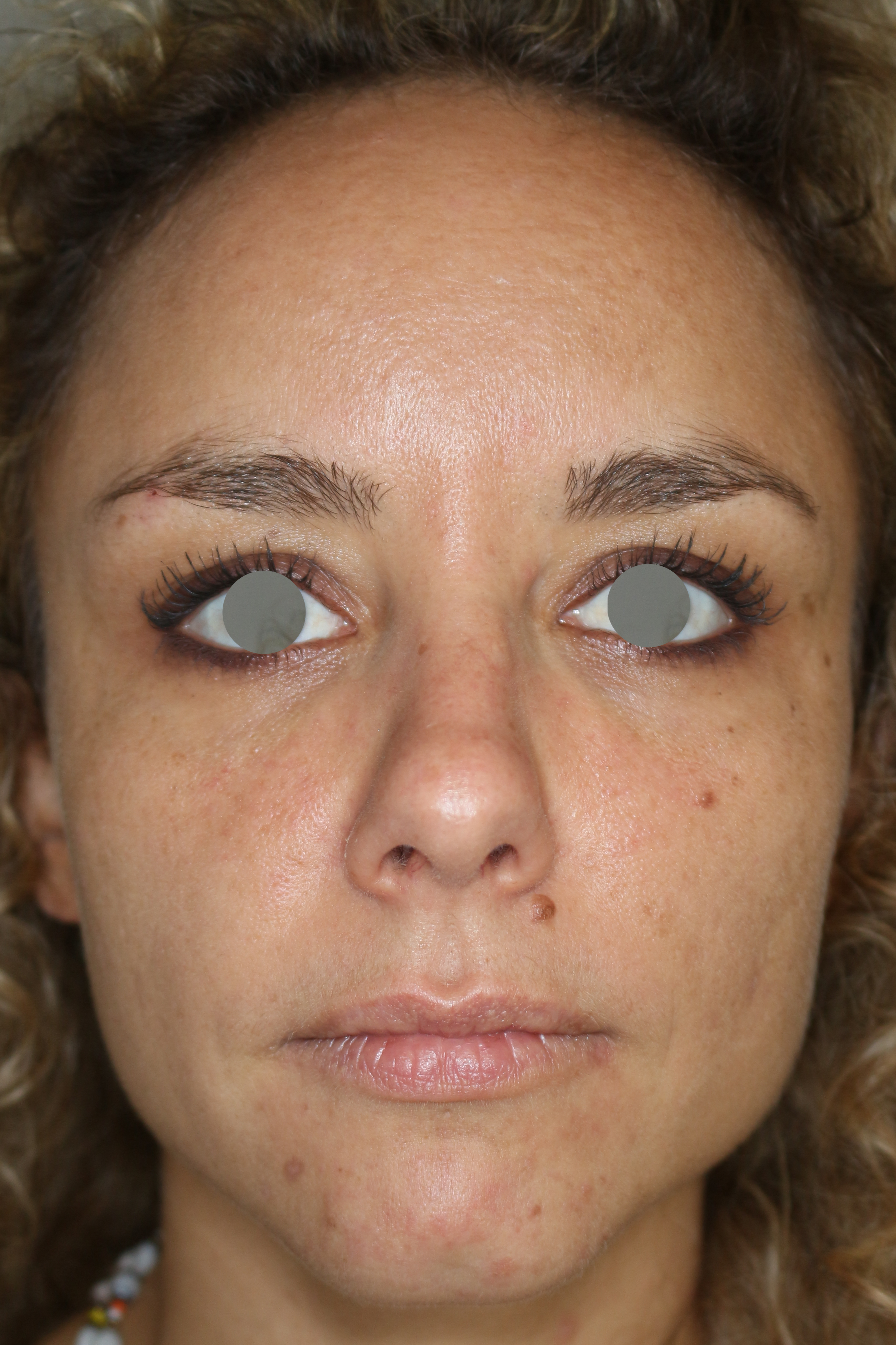 Augenlid- und Wangenmodellierung Before & After Patient #1439