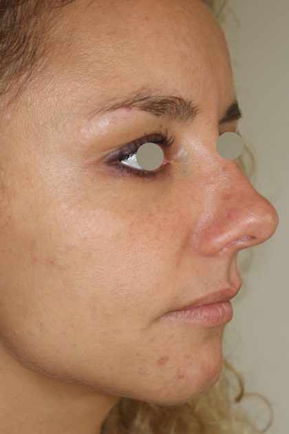 Augenlid- und Wangenmodellierung Before & After Patient #1439