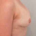 Brustvergrösserung (Eigenfetttransfer) Before & After Patient #1636