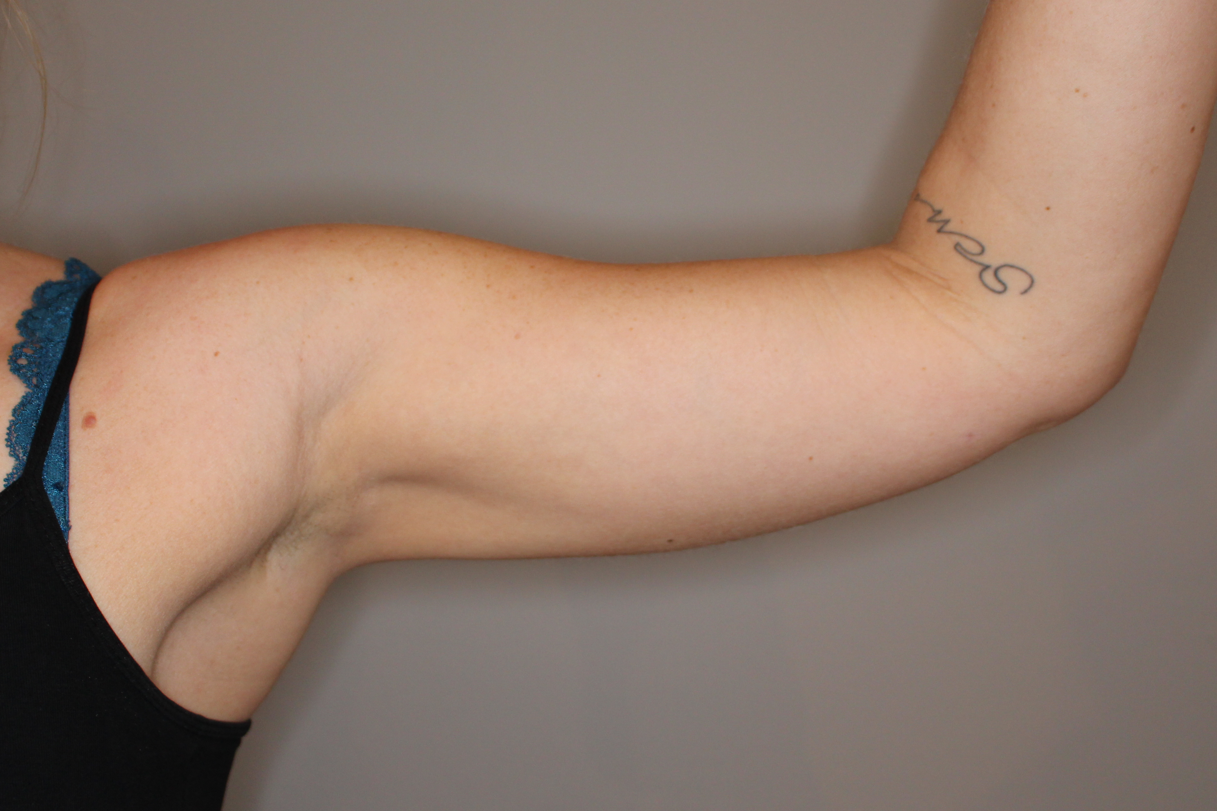 Fettabsaugung Before & After Patient #2073