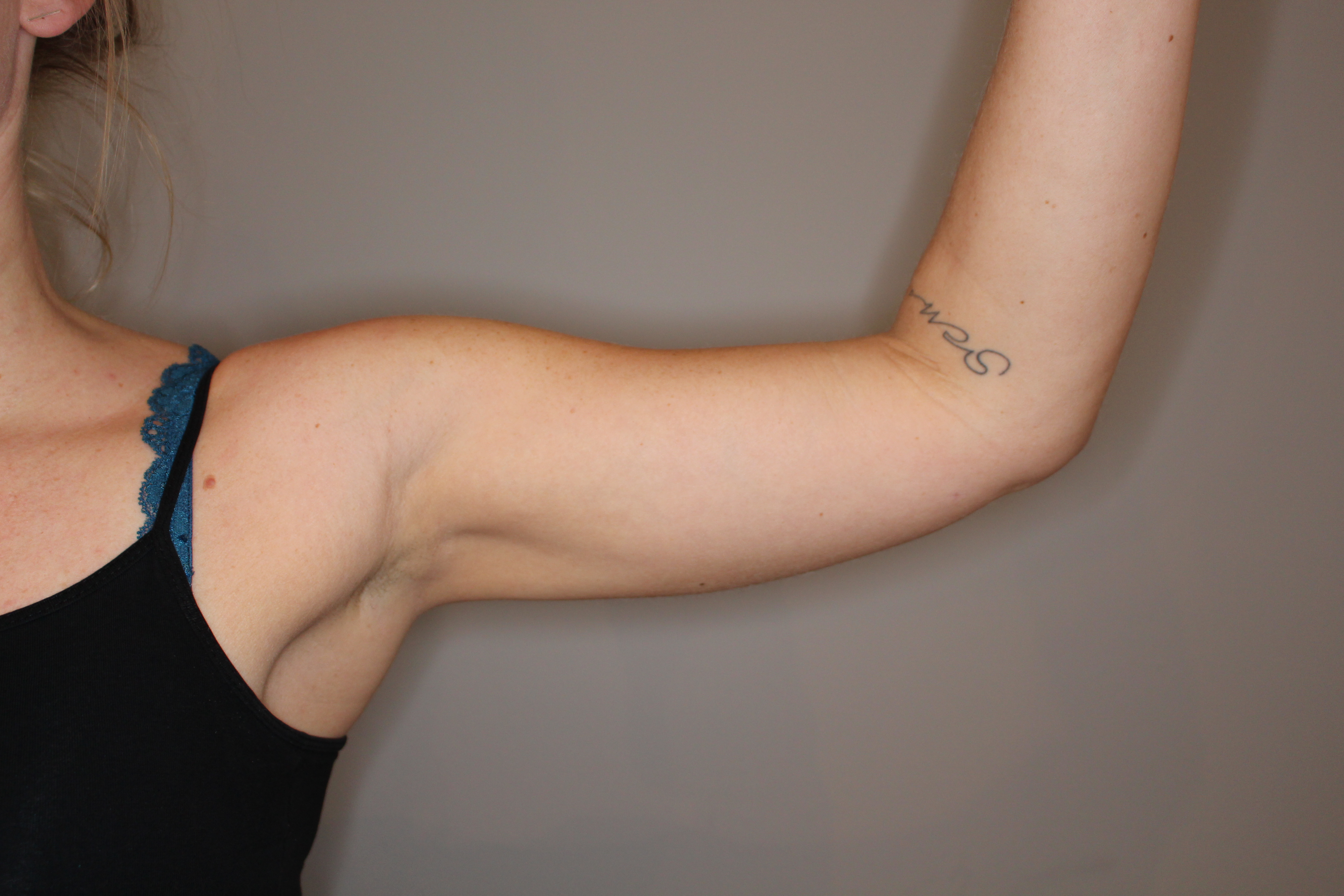Fettabsaugung Before & After Patient #2073