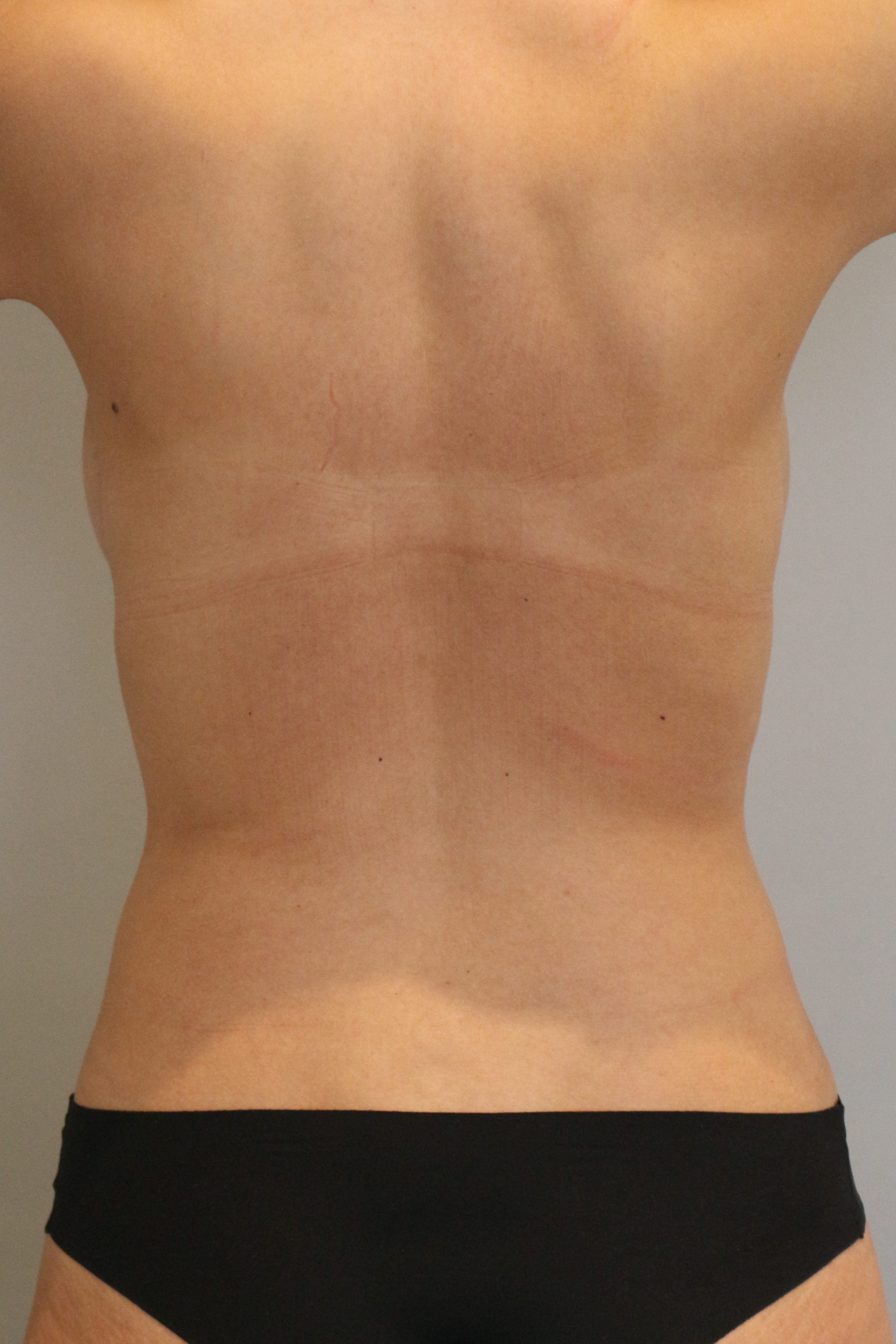 Fettabsaugung Before & After Patient #2087