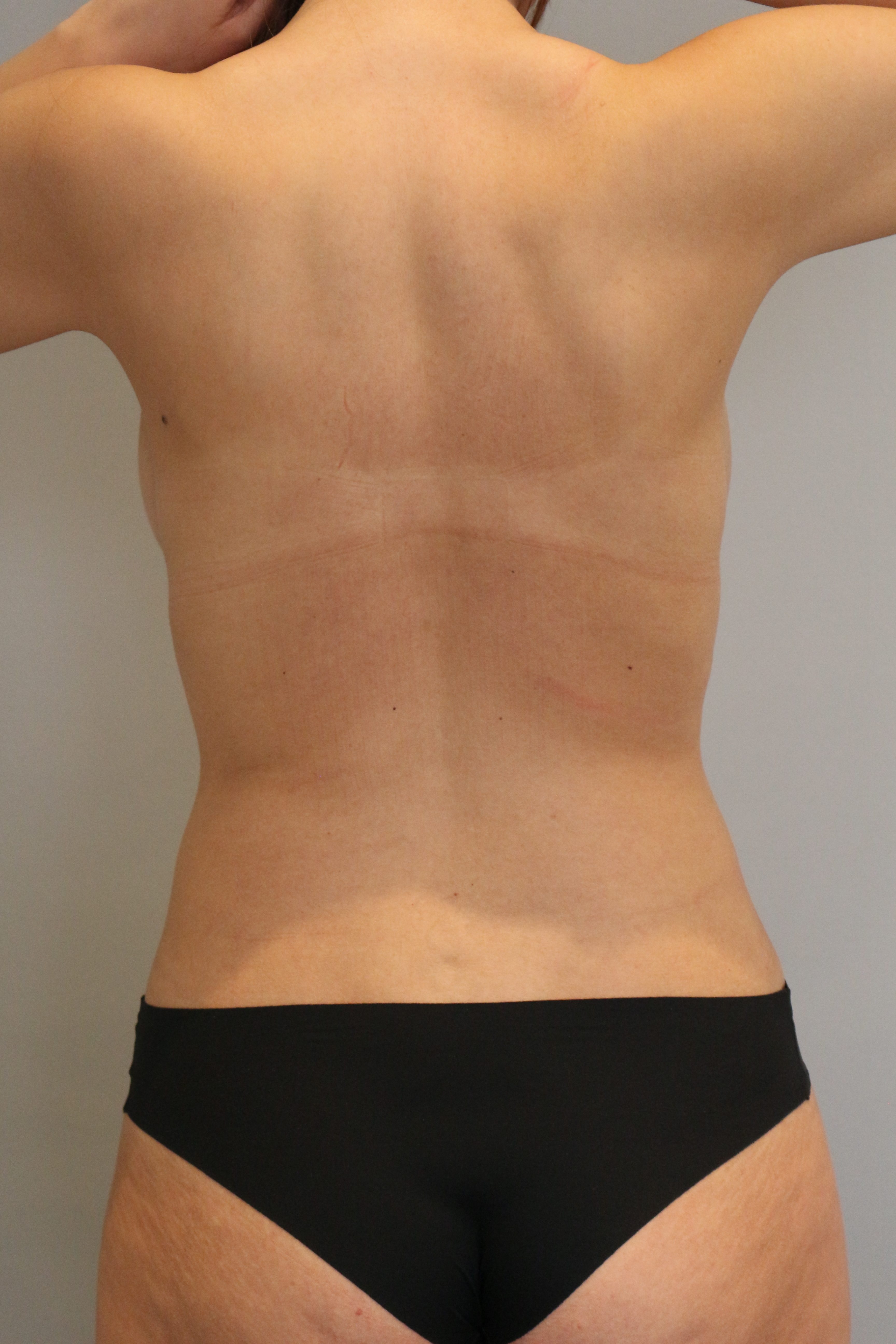 Fettabsaugung Before & After Patient #2087