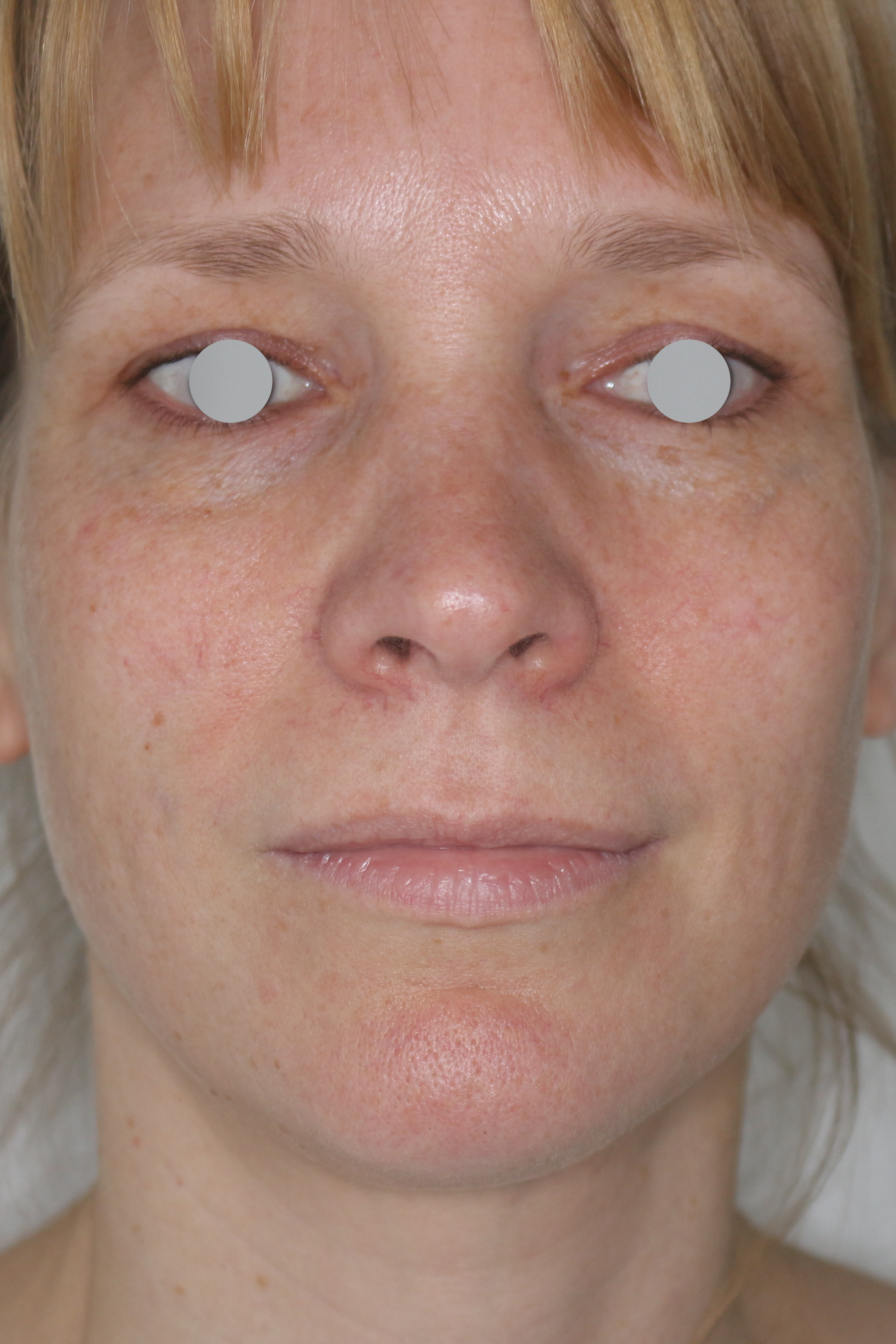 Hautunterspritzungen Before & After Patient #2092