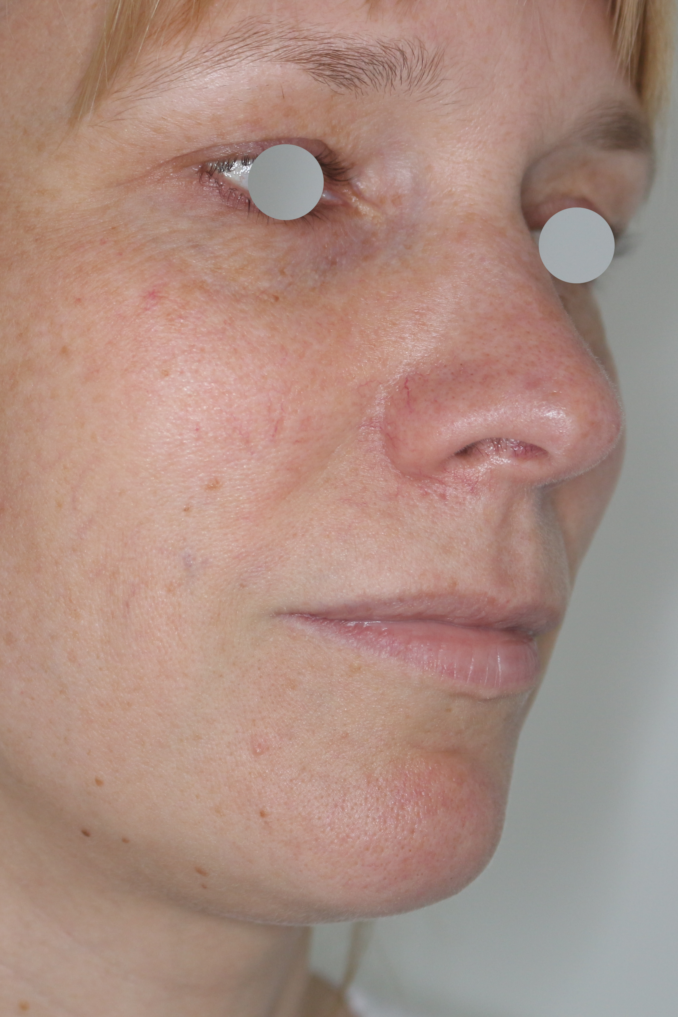 Hautunterspritzungen Before & After Patient #2092