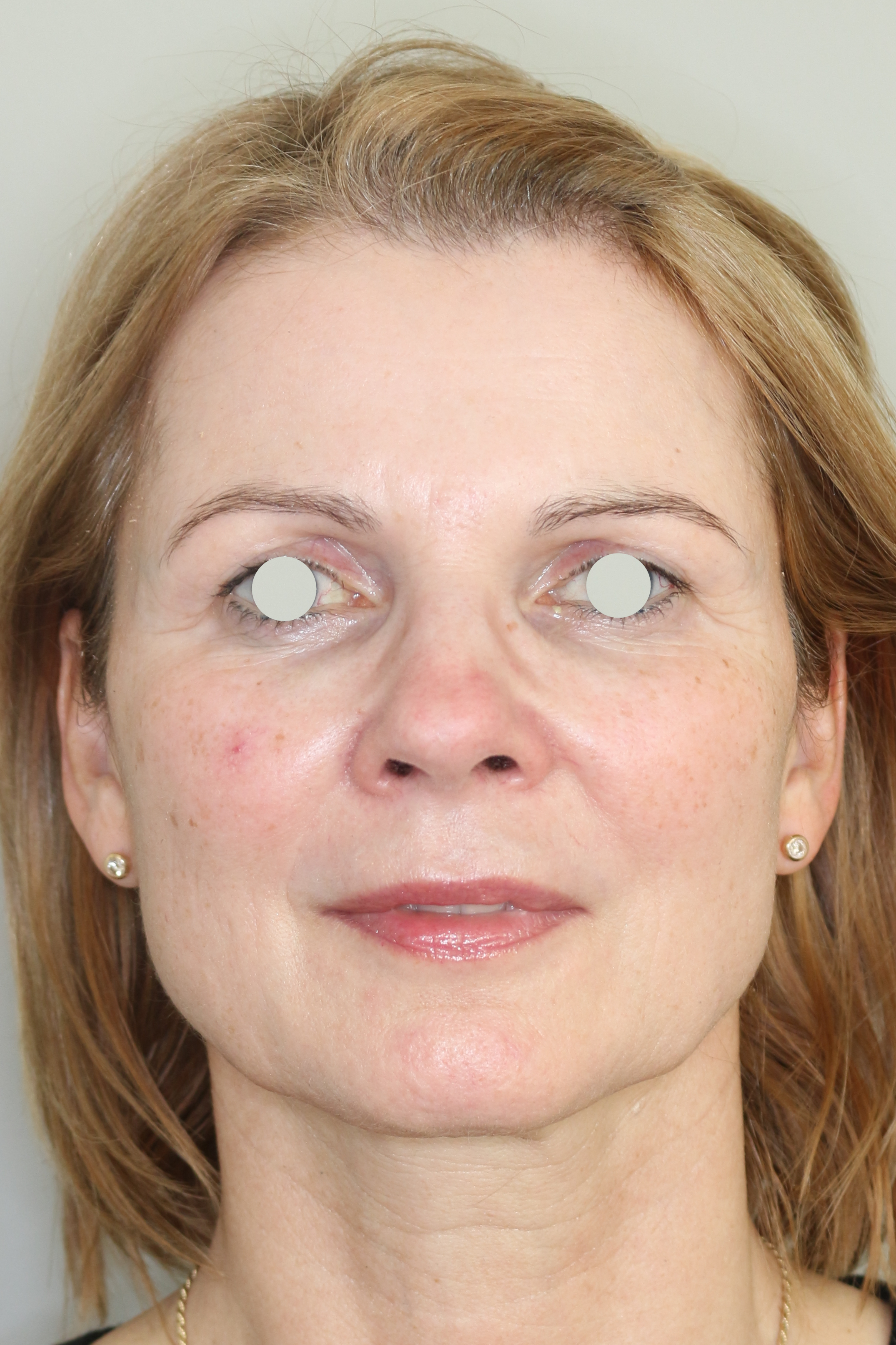 Hautunterspritzungen Before & After Patient #2088