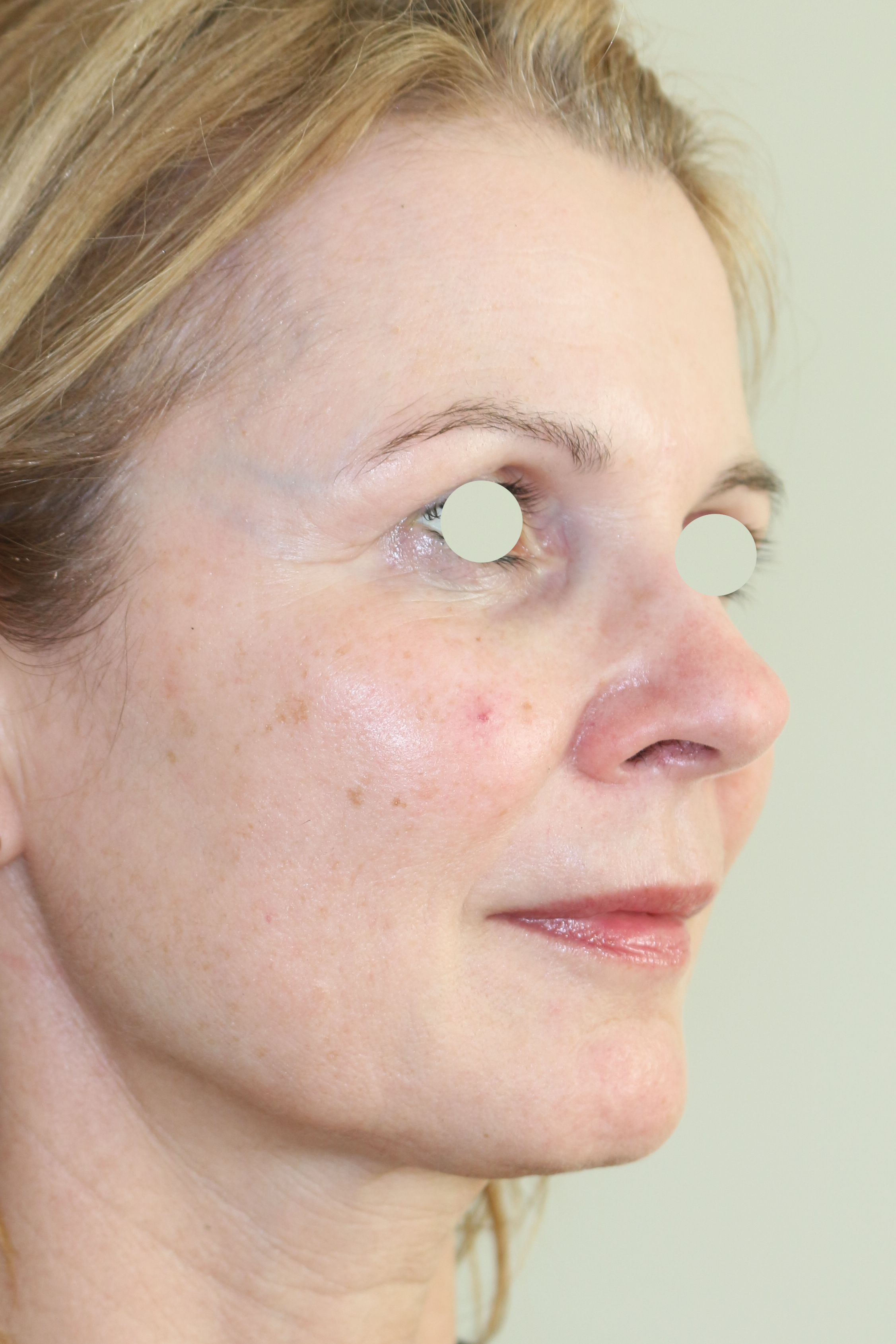 Hautunterspritzungen Before & After Patient #2088
