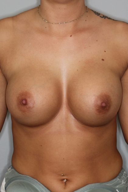 Brustvergrösserung (Runde Implantate) Before & After Patient #2058