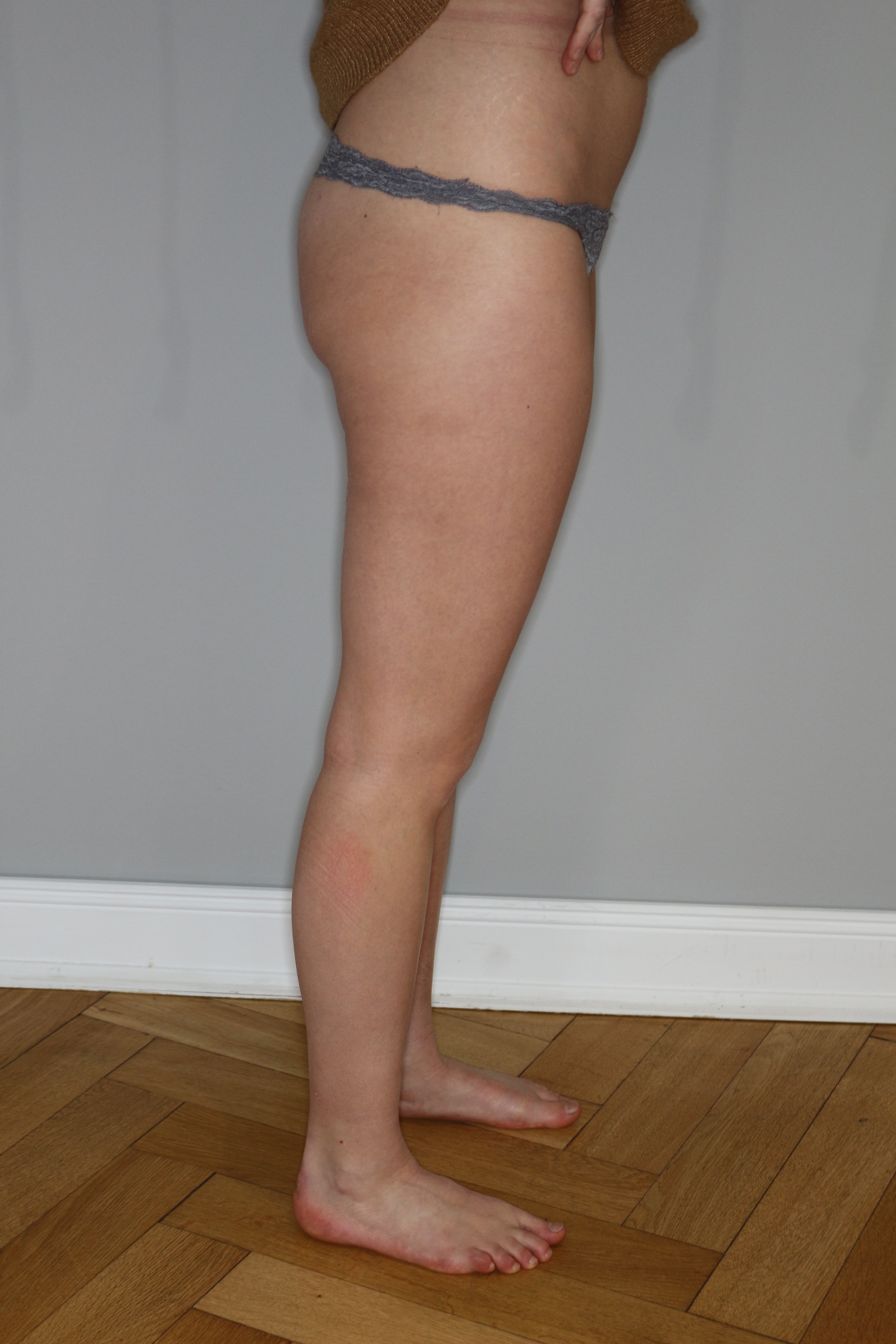 Fettabsaugung Before & After Patient #2222