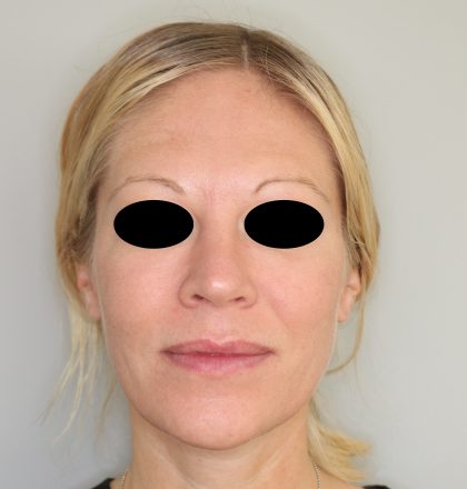 Hautunterspritzungen Before & After Patient #2252