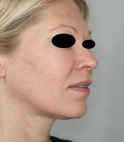Hautunterspritzungen Before & After Patient #2252